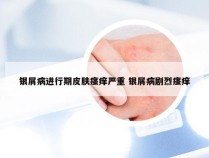 银屑病进行期皮肤瘙痒严重 银屑病剧烈瘙痒