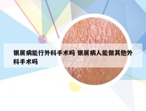 银屑病能行外科手术吗 银屑病人能做其他外科手术吗