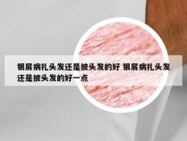 银屑病扎头发还是披头发的好 银屑病扎头发还是披头发的好一点