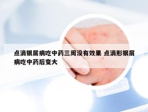 点滴银屑病吃中药三周没有效果 点滴形银屑病吃中药后变大