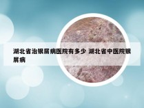 湖北省治银屑病医院有多少 湖北省中医院银屑病