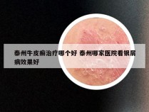 泰州牛皮癣治疗哪个好 泰州哪家医院看银屑病效果好