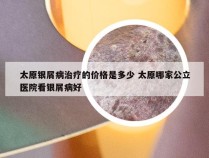 太原银屑病治疗的价格是多少 太原哪家公立医院看银屑病好